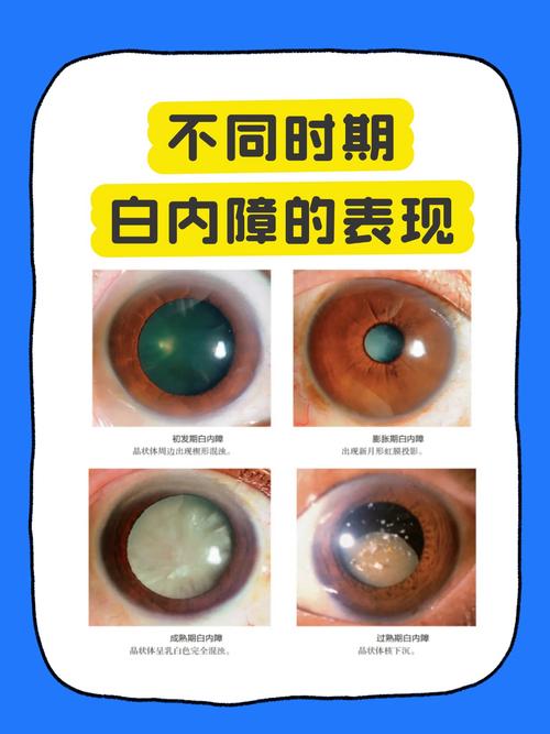 老年性白内障早期看灯光重影示意图