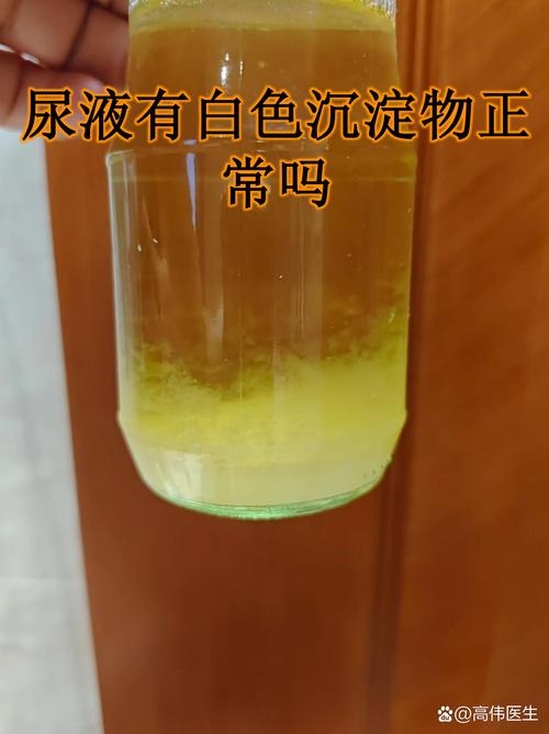 不同日常饮水量尿液沉淀物对比图
