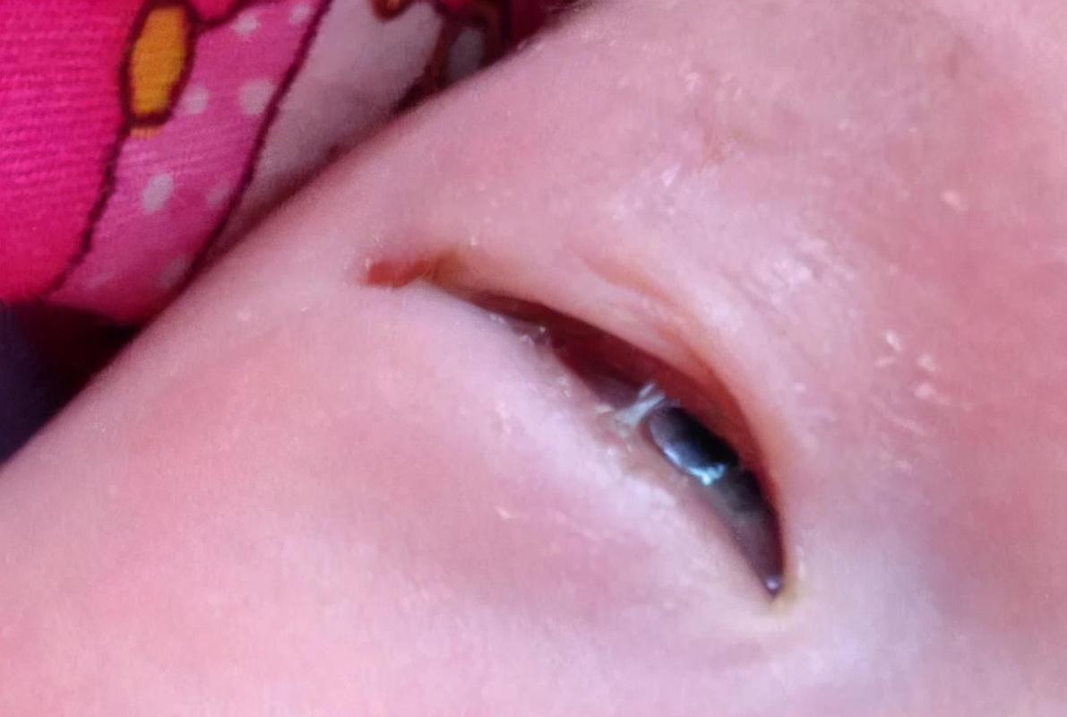 新生儿不同状态眼部分泌物对比图