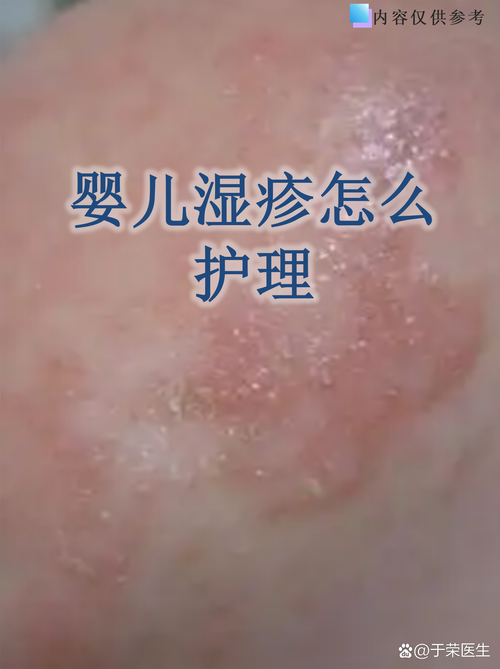 婴儿严重湿疹糜烂渗水皮肤护理