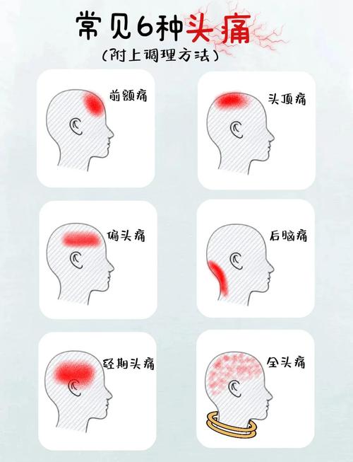偏头痛发作先兆常见表现手绘示意图