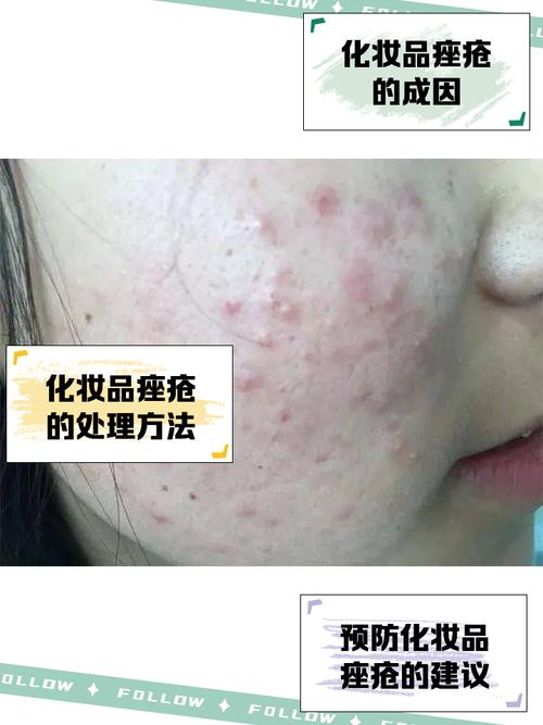 堆叠护肤品导致闷痘的示意图
