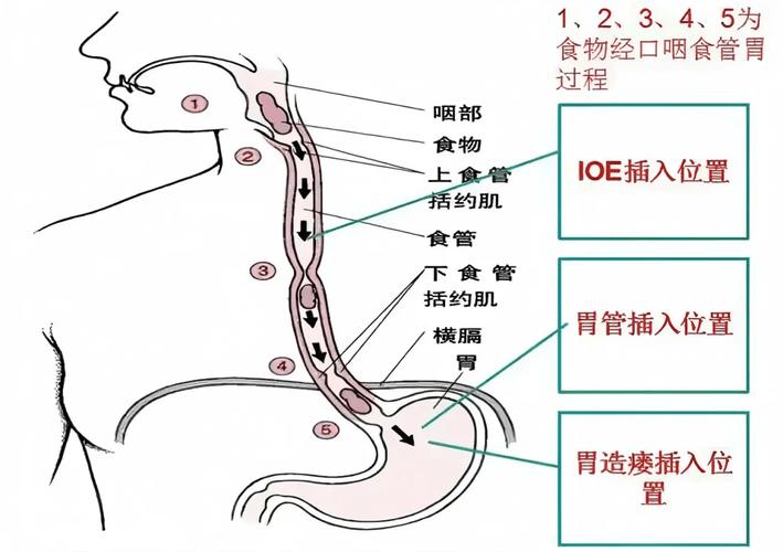 快速进食吞咽空气进入胃部示意图