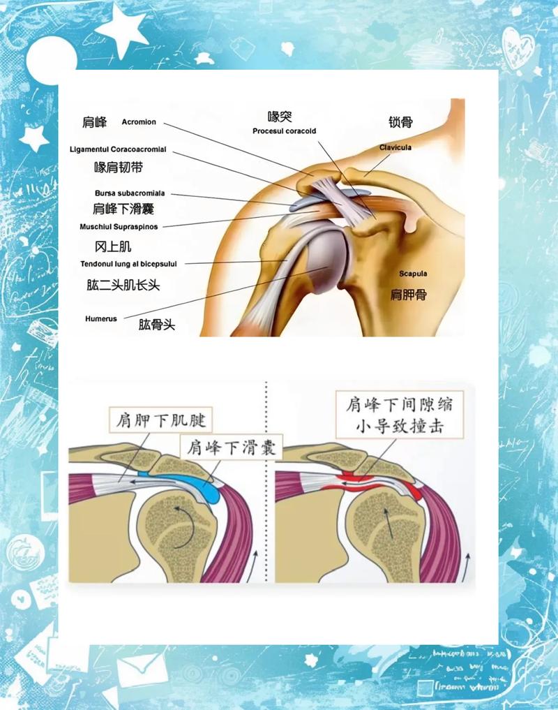 人体肩峰撞击综合征解剖示意图