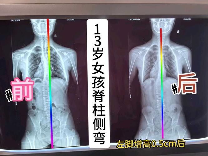 儿童脊柱侧弯的X光片与外观对比图