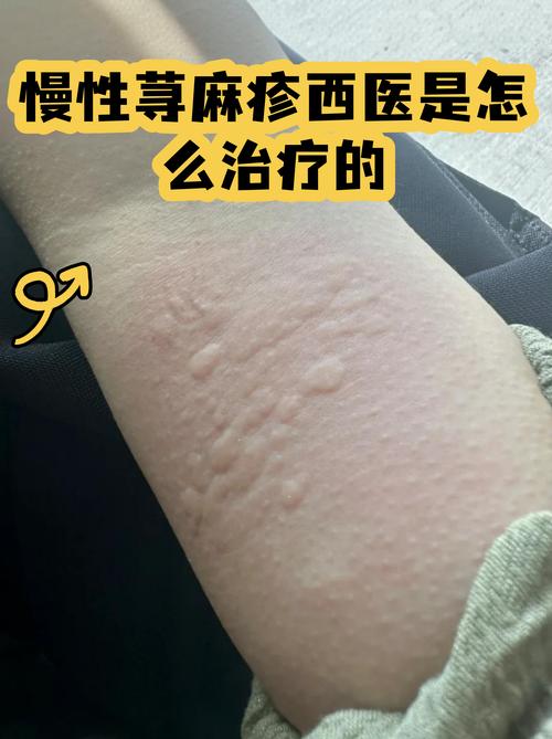 慢性荨麻疹患者胳膊上风团实拍
