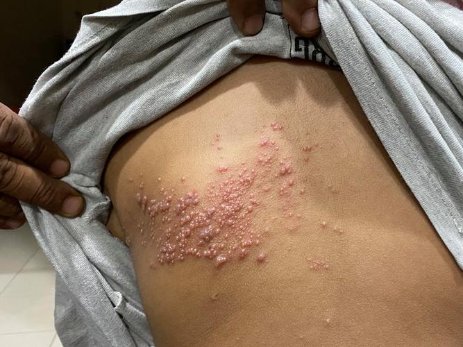 腰部带状疱疹结痂恢复后皮肤图