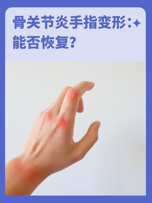 扩散模型手部生成失败案例 六根手指 扭曲变形