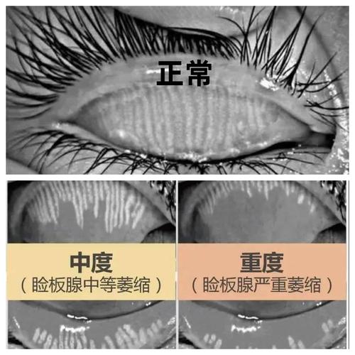 干眼症睑板腺萎缩对比图