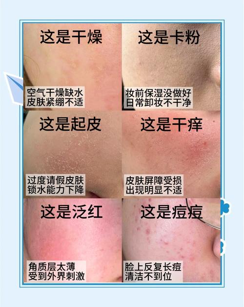 秋季皮肤干燥起皮保湿护理