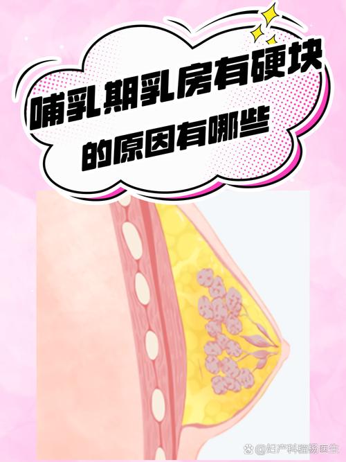 哺乳期早期堵奶硬块位置示意图