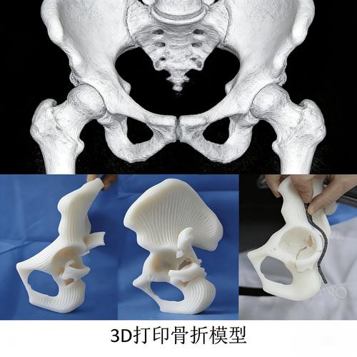 医院术前规划用3D打印人体骨盆模型