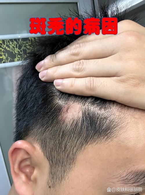 基因编辑：罕见病之外，开始盯上脱发了？