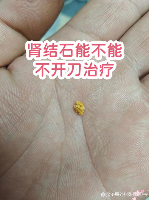 得了结石一定要开刀？真不一定