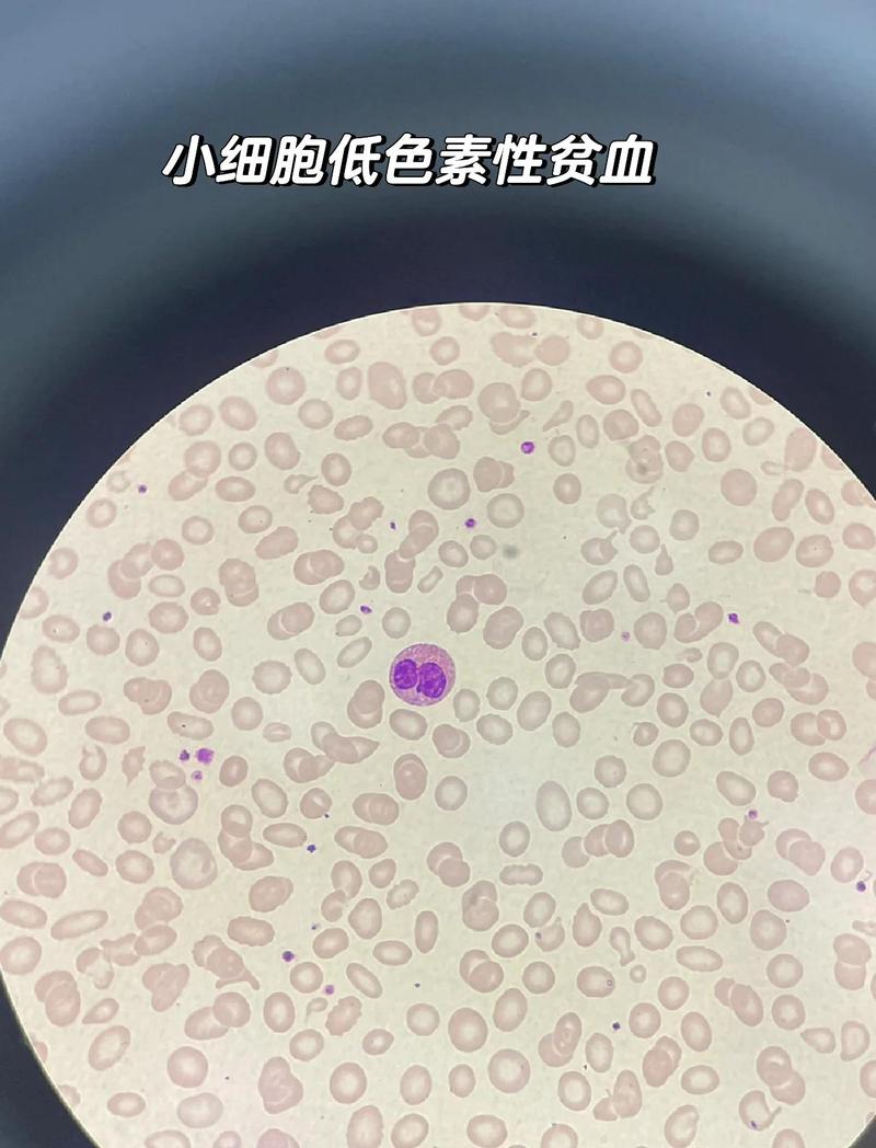 镰状细胞病患者接受基因编辑治疗前后血液红细胞对比图像