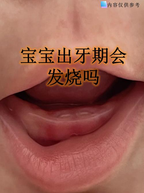 必须立刻就医的宝宝出牙不适红线