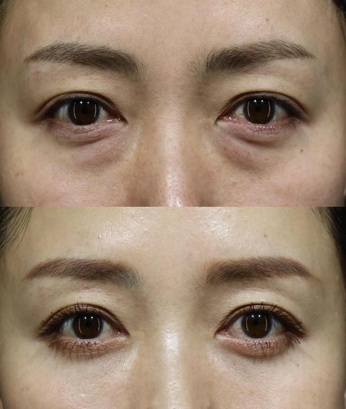 卫生间暖光镜前灯下水肿型眼袋与脂肪型眼袋对比实拍
