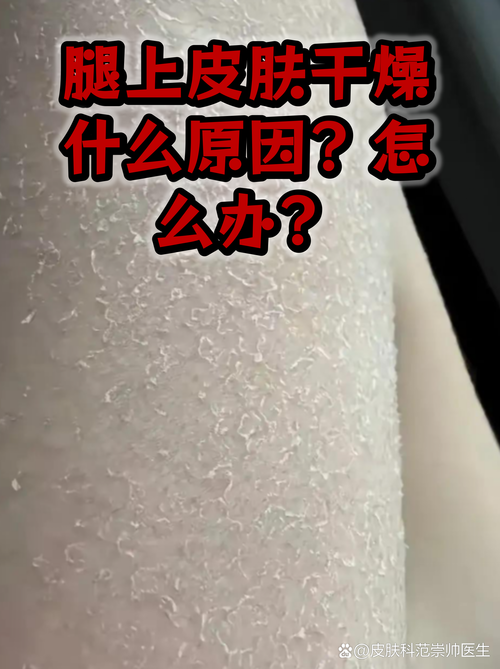 干性皮肤小腿起白屑保湿护理示意