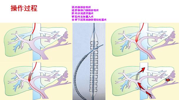 液压系统里的“血管接驳术”