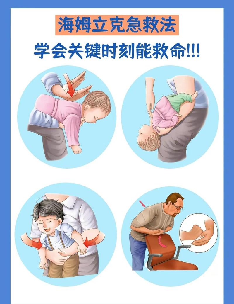 海姆立克急救法成人腹部冲击操作示意图