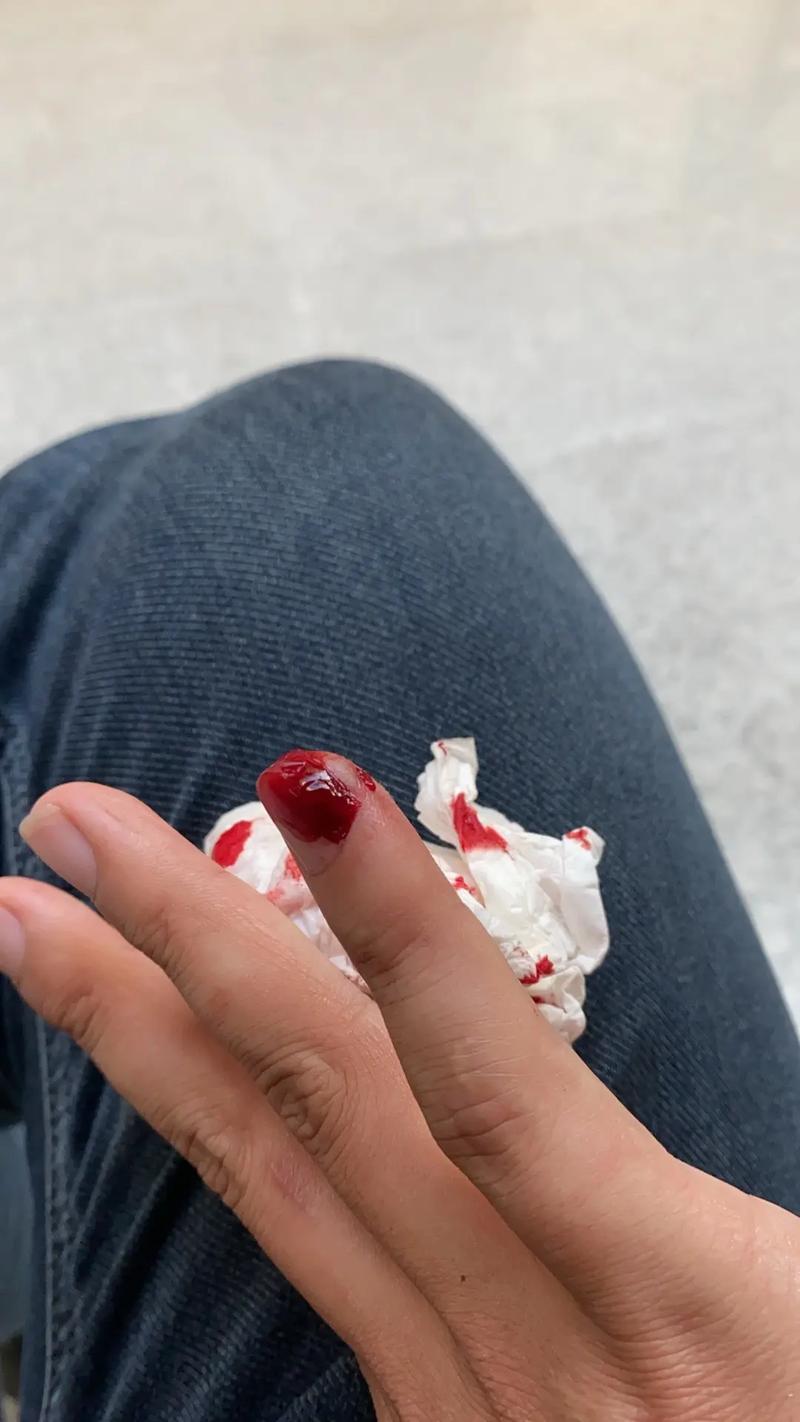 一位女性手指被荆棘刺伤后渗出血珠的特写