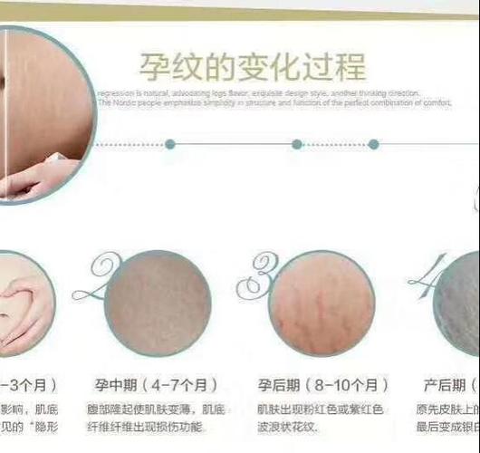 皮:妊娠纹是勋章?不,是护理没到位
