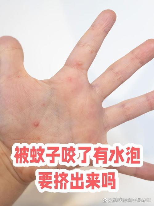 真要挤，怎么动手不挨咬