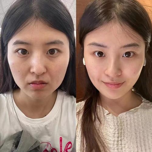 女生在家使用美容仪器前后对比实拍