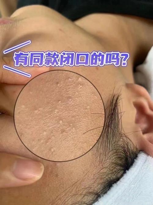 护肤步骤错误导致闭口图片