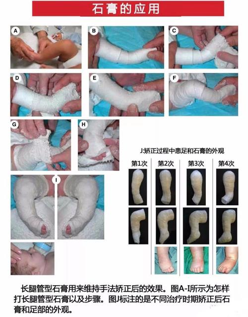 婴幼儿手足印翻模模具加固示意图