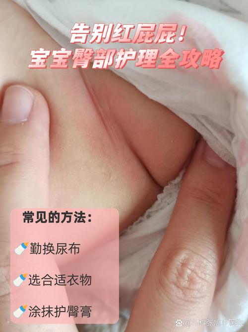 轻度宝宝红臀臀部护理操作实拍图