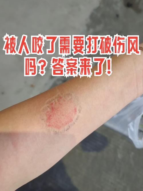 真被咬了，第一件事不是吵架，是处理伤口