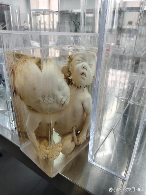 医学院人体标本馆内的畸形胎儿