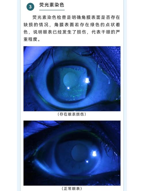 干眼症患者角膜荧光素染色检查图
