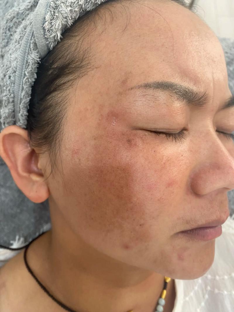 光敏性精油外用后暴晒导致皮肤色素沉淀