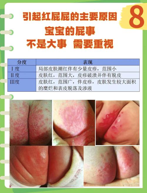 新生儿不同程度红屁屁对比图