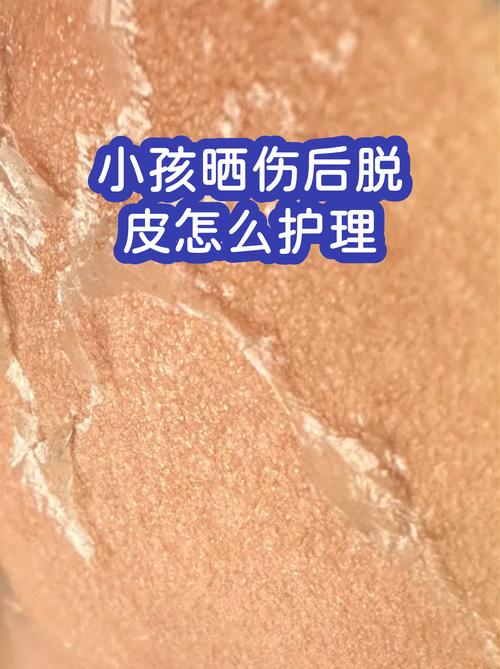 宝宝轻度重度晒伤症状对照图