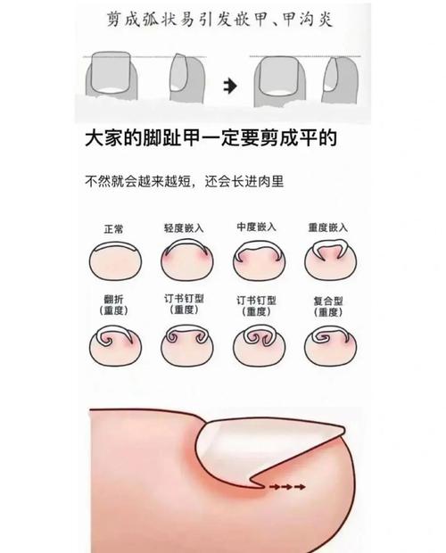 手指甲脚趾甲正确剪法对比图