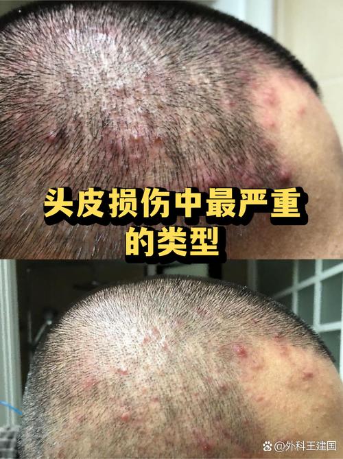 这些不起眼的坏习惯,最伤头皮
