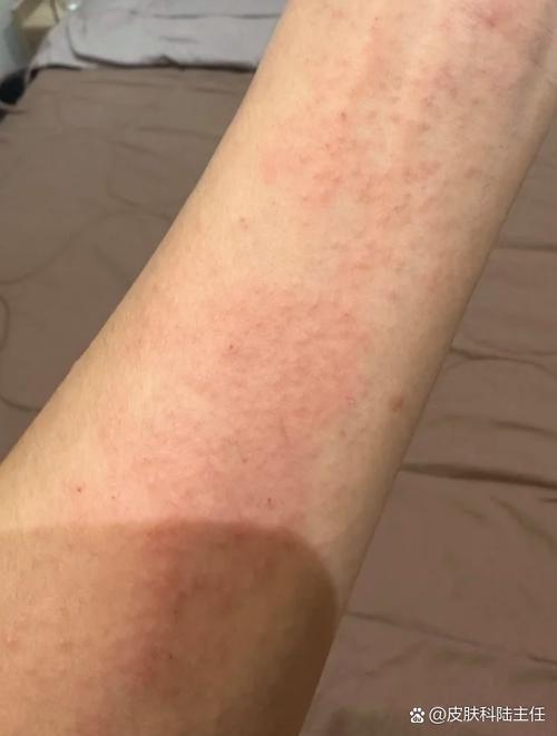 人手臂接触宠物后起红疹过敏症状