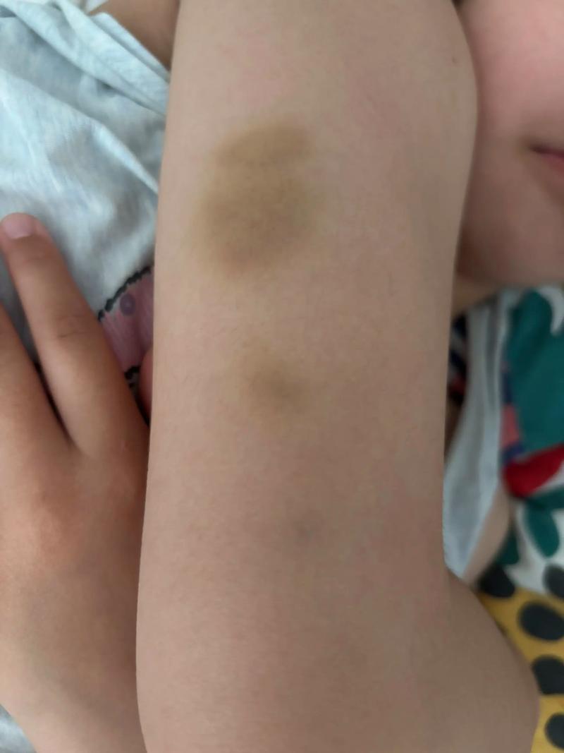 孩子胳膊淤青照片证据