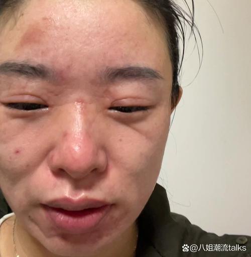 新娘敷面膜后面部泛红过敏特写