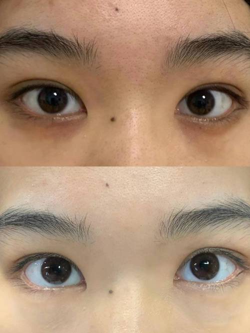 熬夜后黑眼圈和正常眼睛对比图