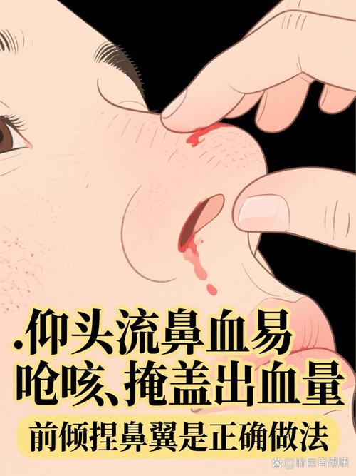 流鼻血：仰头是错的，捏鼻子才对