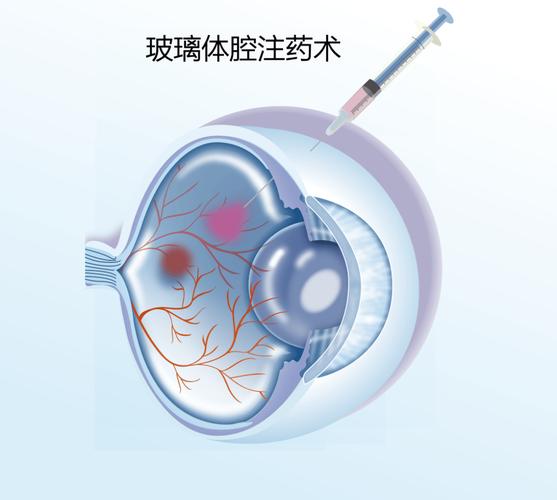 基因编辑治疗遗传性失明视网膜注射示意图