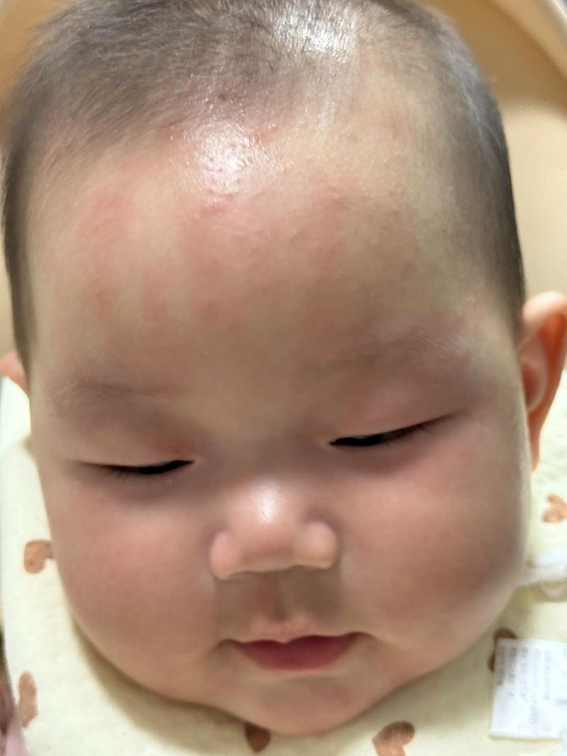 过敏宝宝脸部湿疹特写镜头