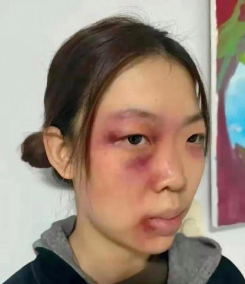 家暴受害者验伤照片