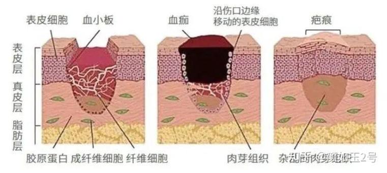 脑机接口电极植入后胶质瘢痕形成示意图