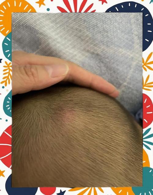 别揉完肿包抹红花油!正确宝宝摔伤处理全指南-超级宝贝