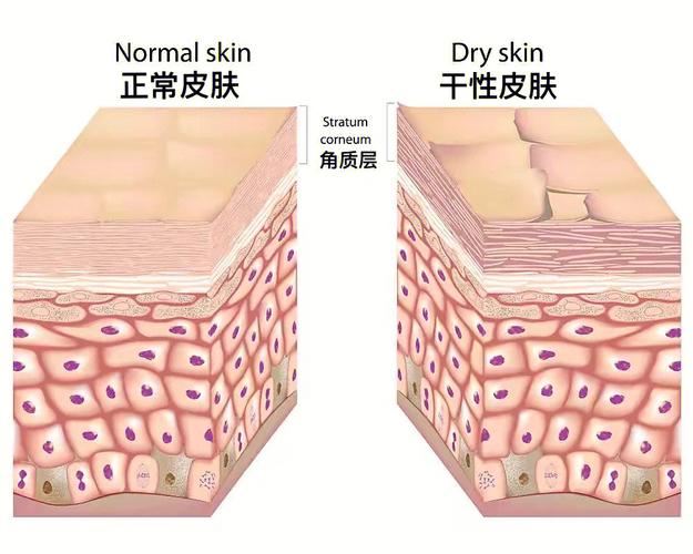 健康皮肤屏障与受损皮肤屏障对比示意图